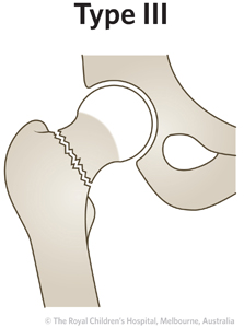 ED Section 1 FEMORAL NECK FRACTURE Type 3